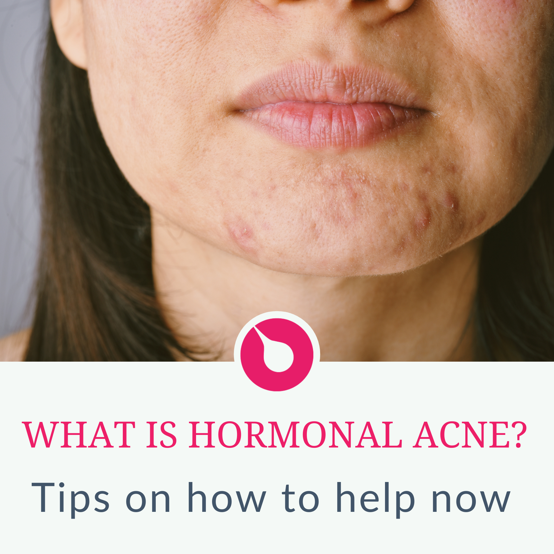 What is hormonal acne 3 tips to help now