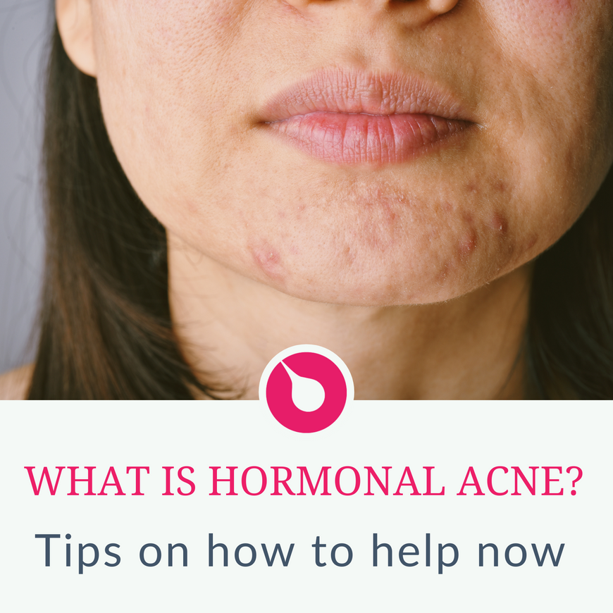What is hormonal acne? 3 tips to help now